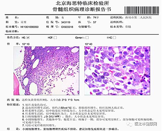 可见原始,幼稚浆细胞,双核,三核浆细胞亦可见,多发性骨髓瘤(mm)骨髓象