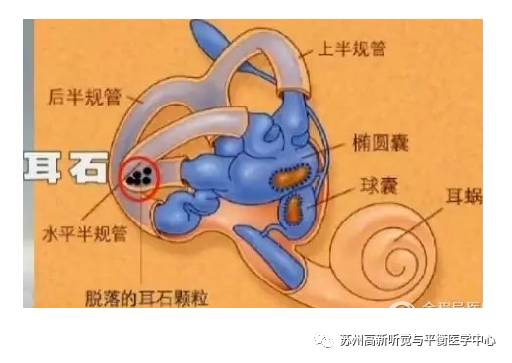 耳石症,是指内耳里负责平衡的椭圆囊内的耳石因各种原因脱落