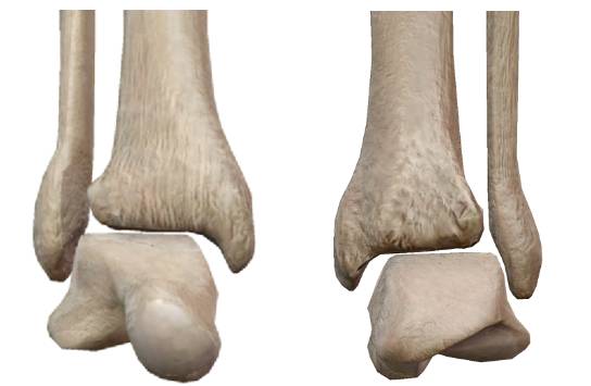 医生揭秘穿高跟鞋9大弊端