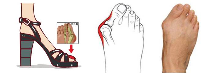 医生揭秘穿高跟鞋9大弊端