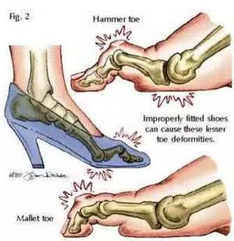 医生揭秘穿高跟鞋9大弊端