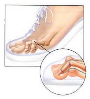 医生揭秘穿高跟鞋9大弊端