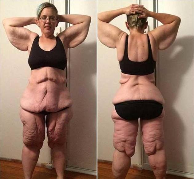 减肥手术有哪些方法_手术减肥_减肥手术多少钱