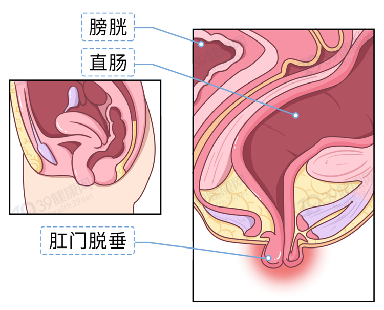 (严重时乙状结肠也会)简单来说就是也叫"直肠脱垂"脱  肛什么是脱肛?