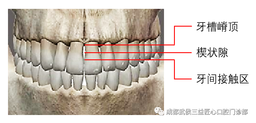 华西口腔医院 李宇 综合解析牙龈"黑三角" 由于牙冠从切缘到牙颈部呈