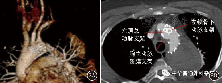 很好的保留了弓上血管(图2),该手术方式为主动脉弓部病变患者的治疗