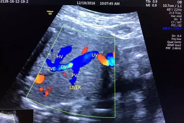 胎儿宫内缺氧静脉导管评估的超声评估