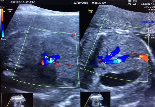 胎儿宫内缺氧静脉导管评估的超声评估