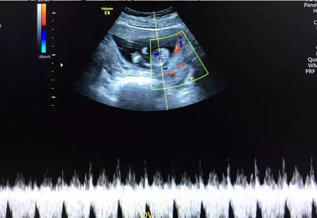 胎儿宫内缺氧静脉导管评估的超声评估
