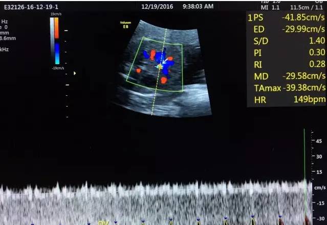胎儿宫内缺氧静脉导管评估的超声评估