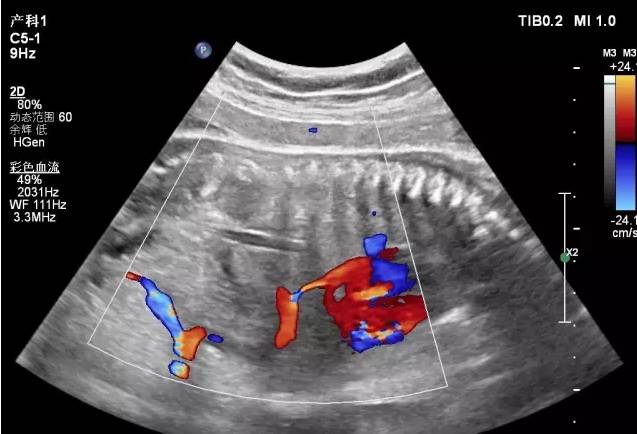 胎儿宫内缺氧静脉导管评估的超声评估