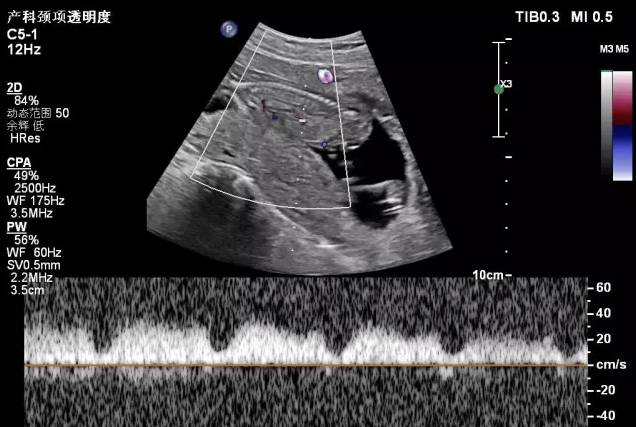 胎儿宫内缺氧静脉导管评估的超声评估