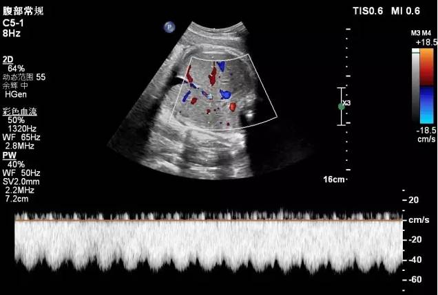 胎儿宫内缺氧静脉导管评估的超声评估