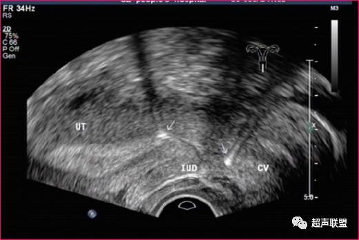 超声观察宫内节育器