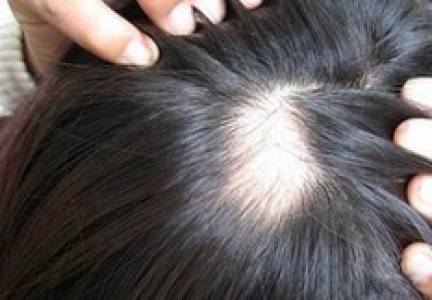 斑秃如何预防与治疗？