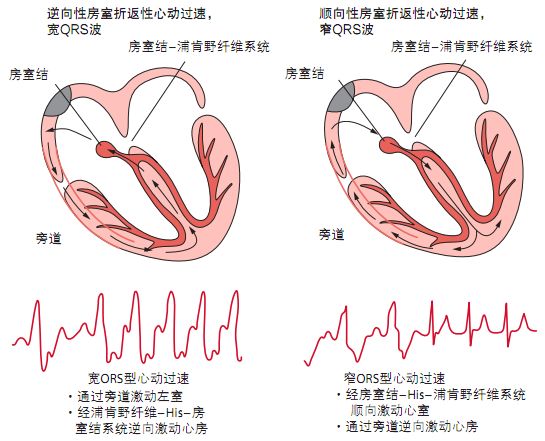 顺向型及逆向型房室折返性心动过速