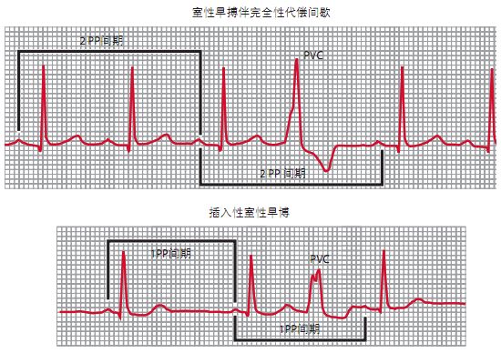 室性早搏可以存在完全性代偿间歇,也可以插入到正常心电图