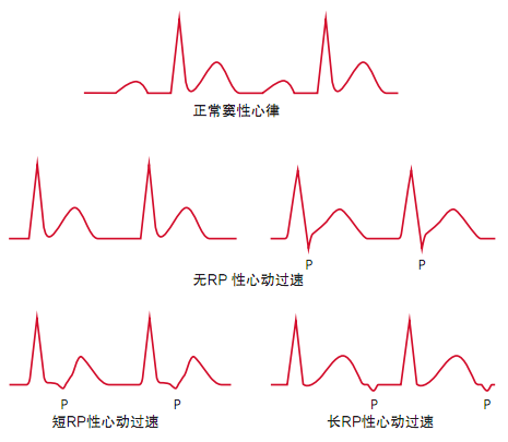 心律失常:心电图分析的两个关键步骤