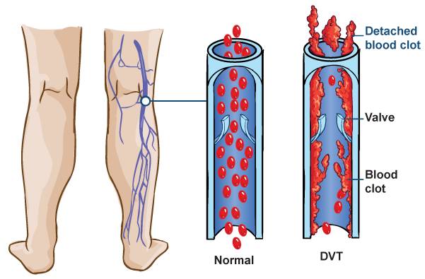 2/3的vte病例为孤立的深静脉血栓形成(dvt,80%是近端的.