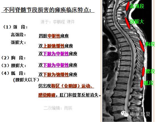 脊髓共分31个节段,包括颈髓8节,胸髓12节,腰髓5节,骶髓5节和1个尾节.