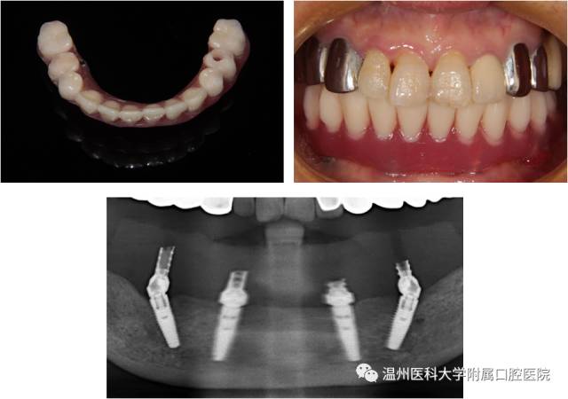 临床病例大赛获奖病例展示丨下颌牙列缺失的aii-on-4