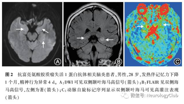 把握中枢神经系统特发性炎性脱髓鞘病与自身免疫性脑炎的诊断与鉴别 神经病学俱乐部