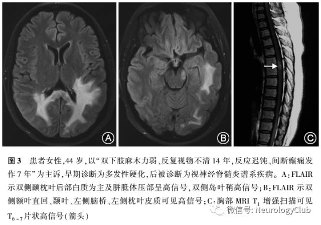 把握中枢神经系统特发性炎性脱髓鞘病与自身免疫性脑炎的诊断与鉴别 神经病学俱乐部