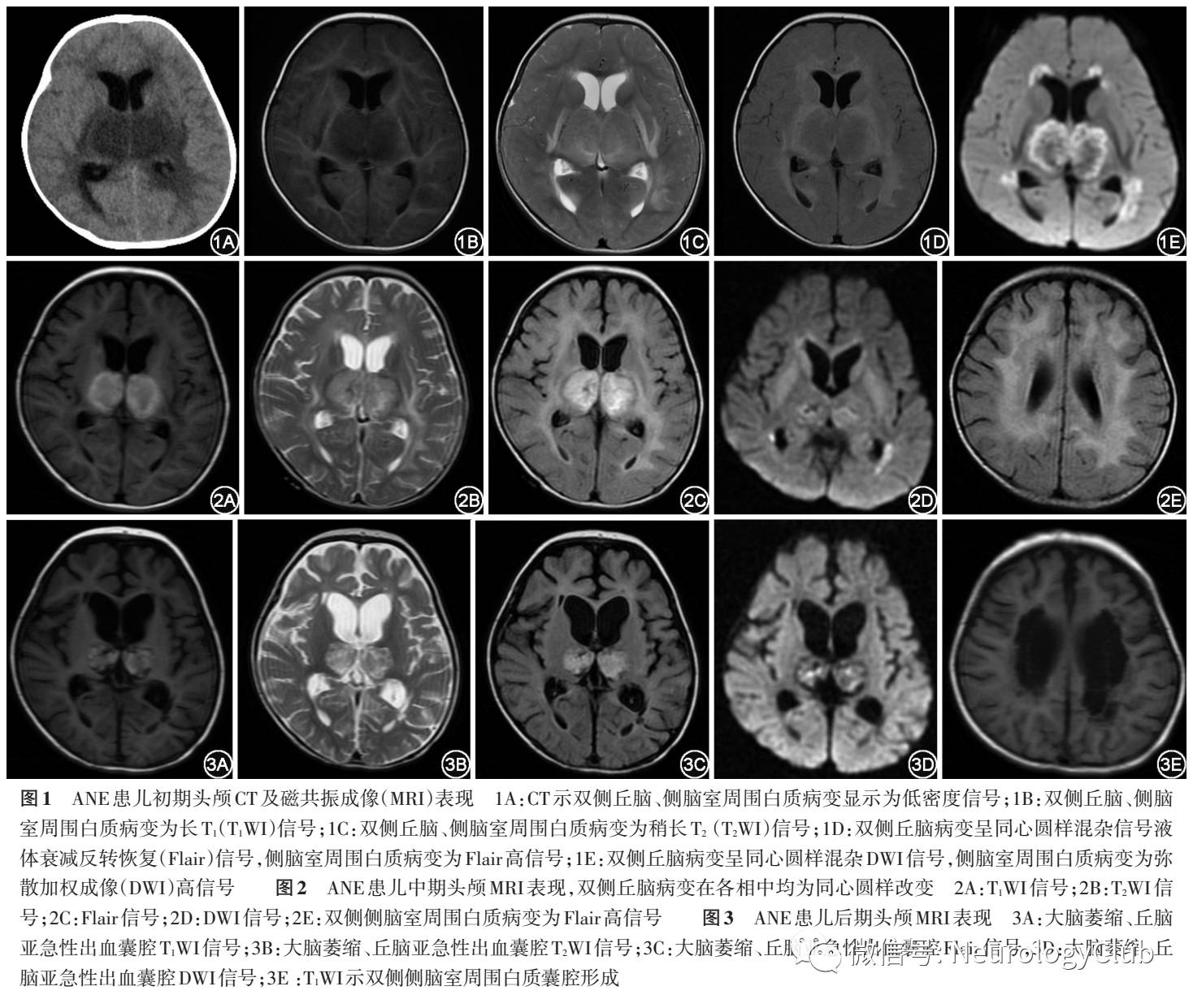 急性坏死性脑病临床影像表现 神经病学俱乐部