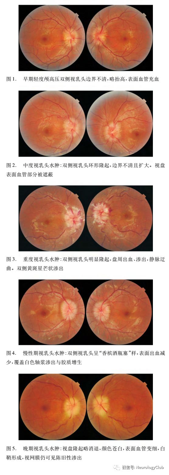 iih导致的视乳头水肿多为双侧对称性,但不除外由于视盘解剖结构差异