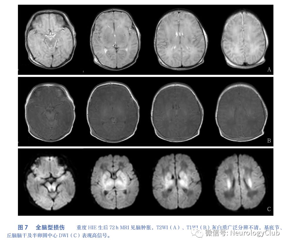 也可累及广泛的白质,受累区域表现为严重脑水肿(脑肿胀),灰白质分辨不