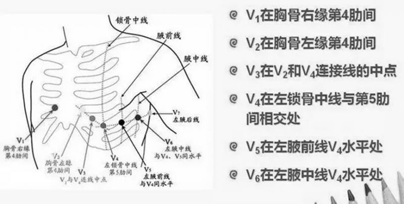 c3(绿色)v2与v4连线的中点; v4或c4(棕色)左锁骨中线与第5肋间相交处