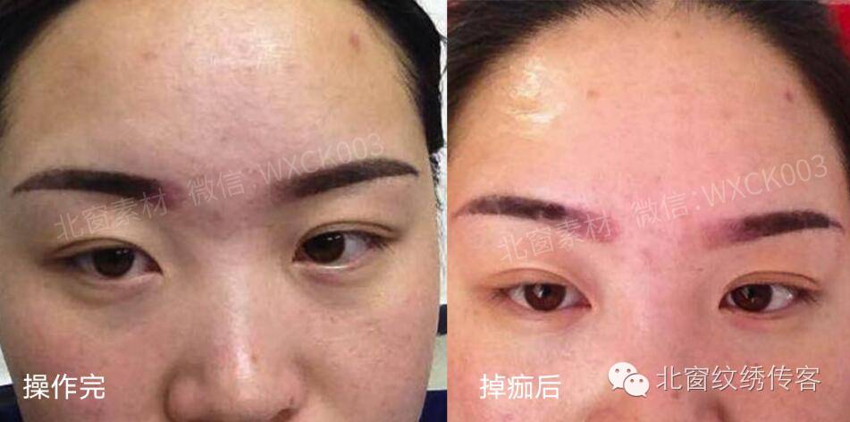 【案例剖析】雾眉掉痂后,没色,发红.