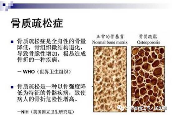 骨质011.jpg