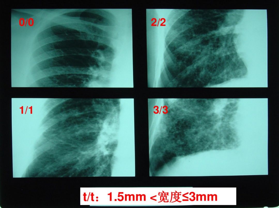 遵义尘肺病医生被抓后,全国掀起学习尘肺病x片的新高潮!