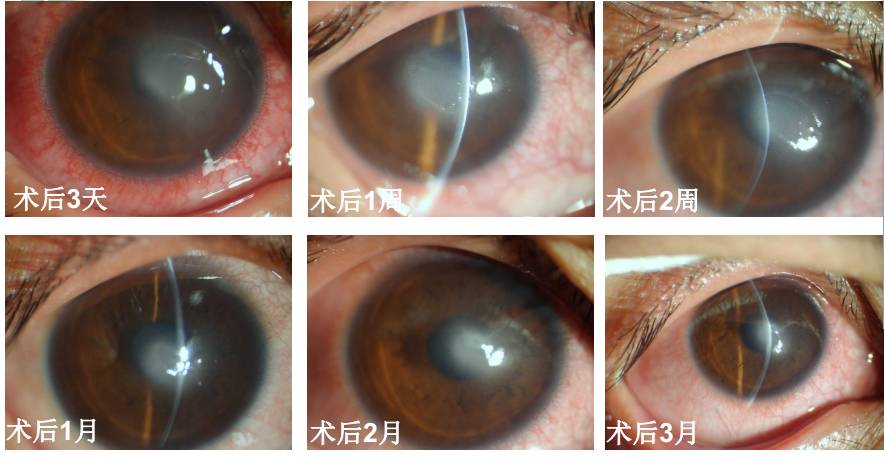 病例2:患者2012年做常规去上皮法术后1天,出现角膜基质层反应,,患者