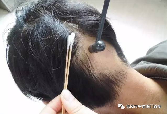中医特色治疗-----梅花针疗法