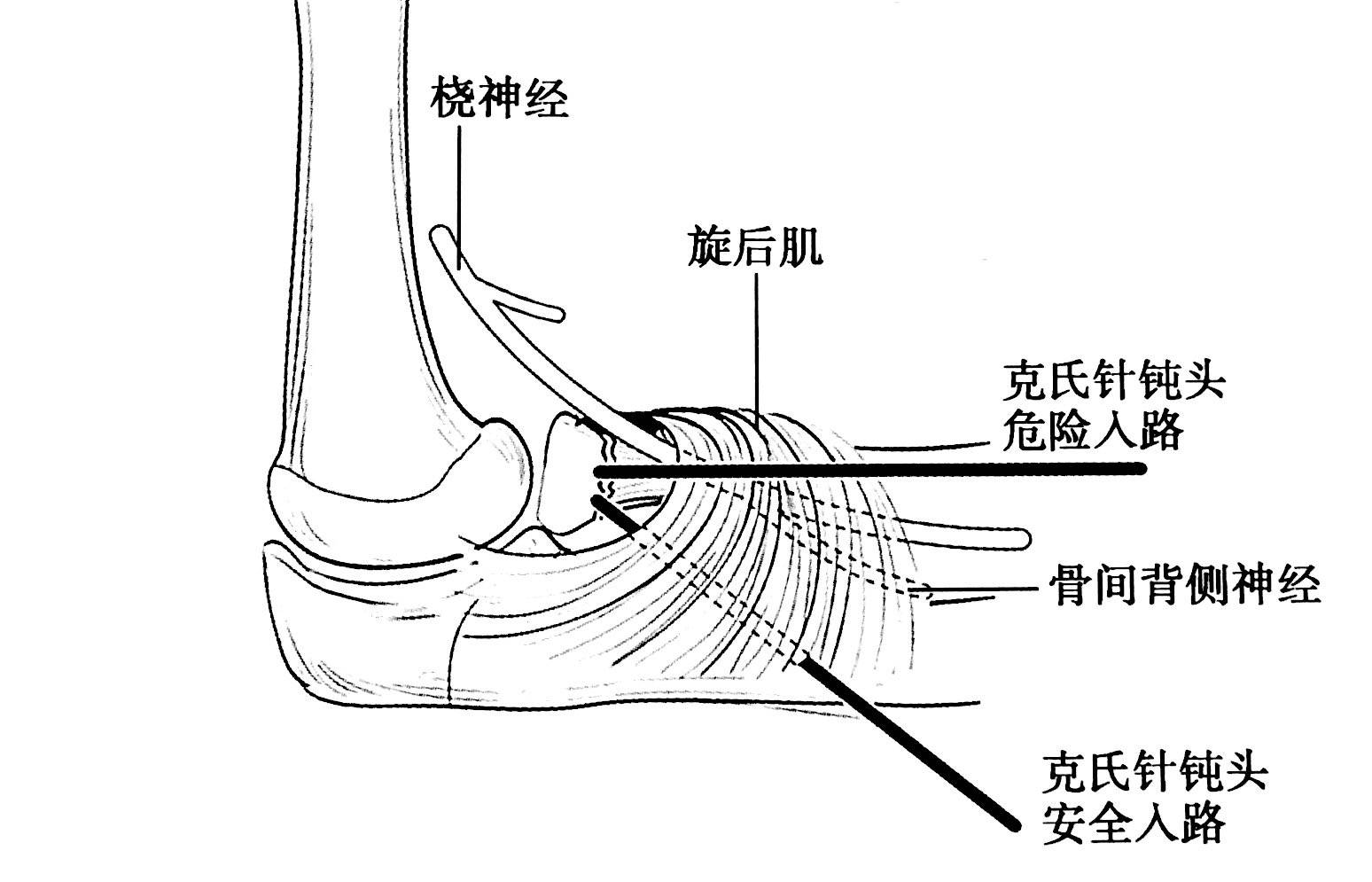 图解儿童桡骨头,颈骨折分型与治疗