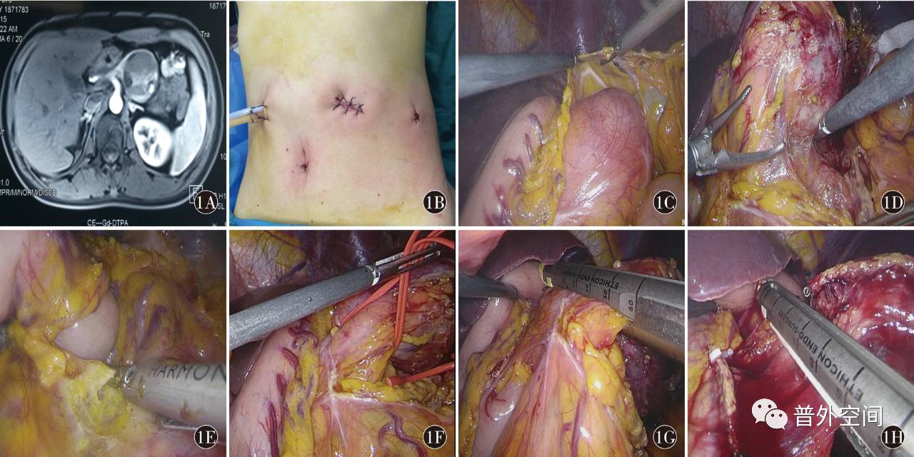 完全腹腔镜保留脾脏胰体尾切除术的临床应用