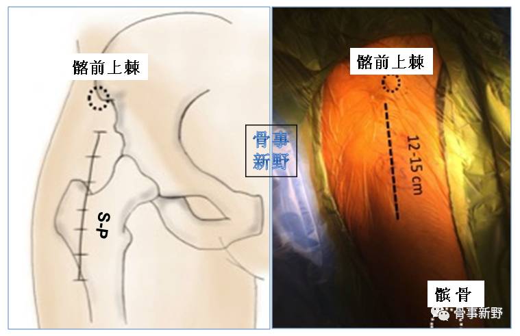 s-p切口起自髂前上棘的下,外2cm,向下朝膝外侧沿线作12-15 cm的皮肤