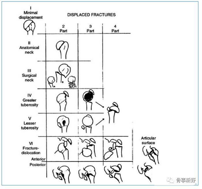 图6. neer分型