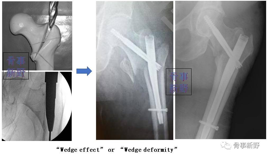 粗隆间骨折髓内钉固定术中出现wedgeeffect的应对技巧骨事新野