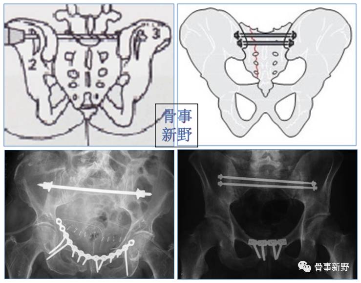 骶骨骨折的手术治疗---骨事新野