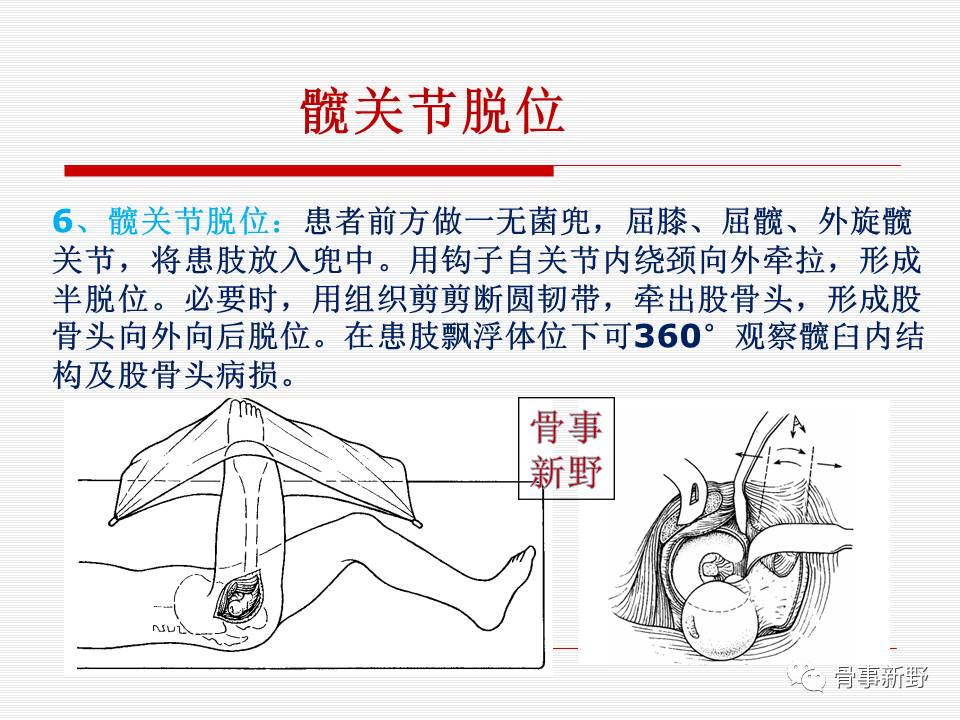 髋关节外科脱位ppt