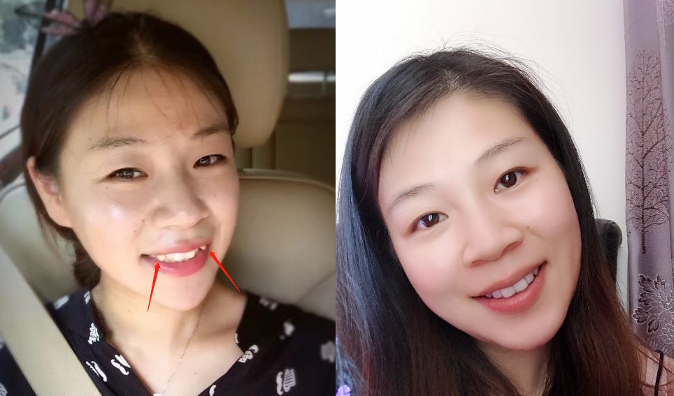 你都这么大了还矫正牙齿干什么