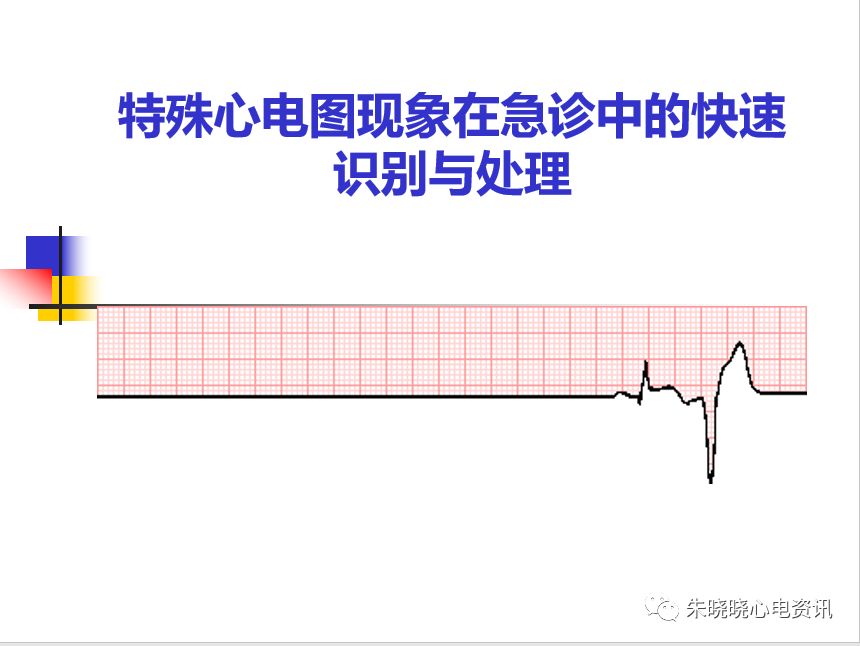 特殊心电图现象在急诊中的快速识别与处理建议收藏