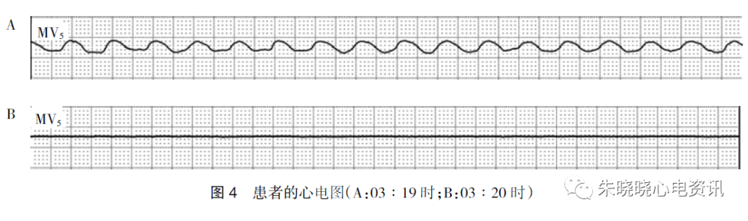 图4b 为03:21 时显示心电消失呈现一条直线.