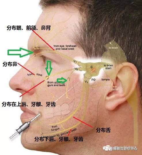 三叉神经痛自我治疗的小偏方