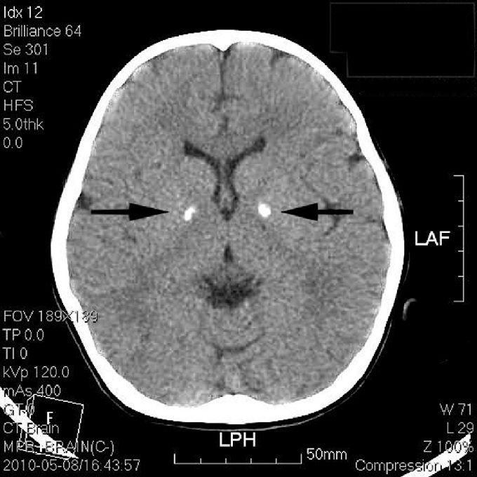 头颅ct提示苍白球钙化