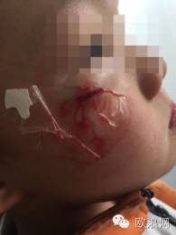 【欧浪网】孩子几乎天天鼻青脸肿回家 是学校看管不利还是另有隐情？