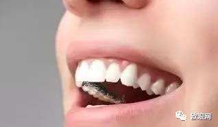 牙齿隐形矫正技术对比——你选择你喜欢！